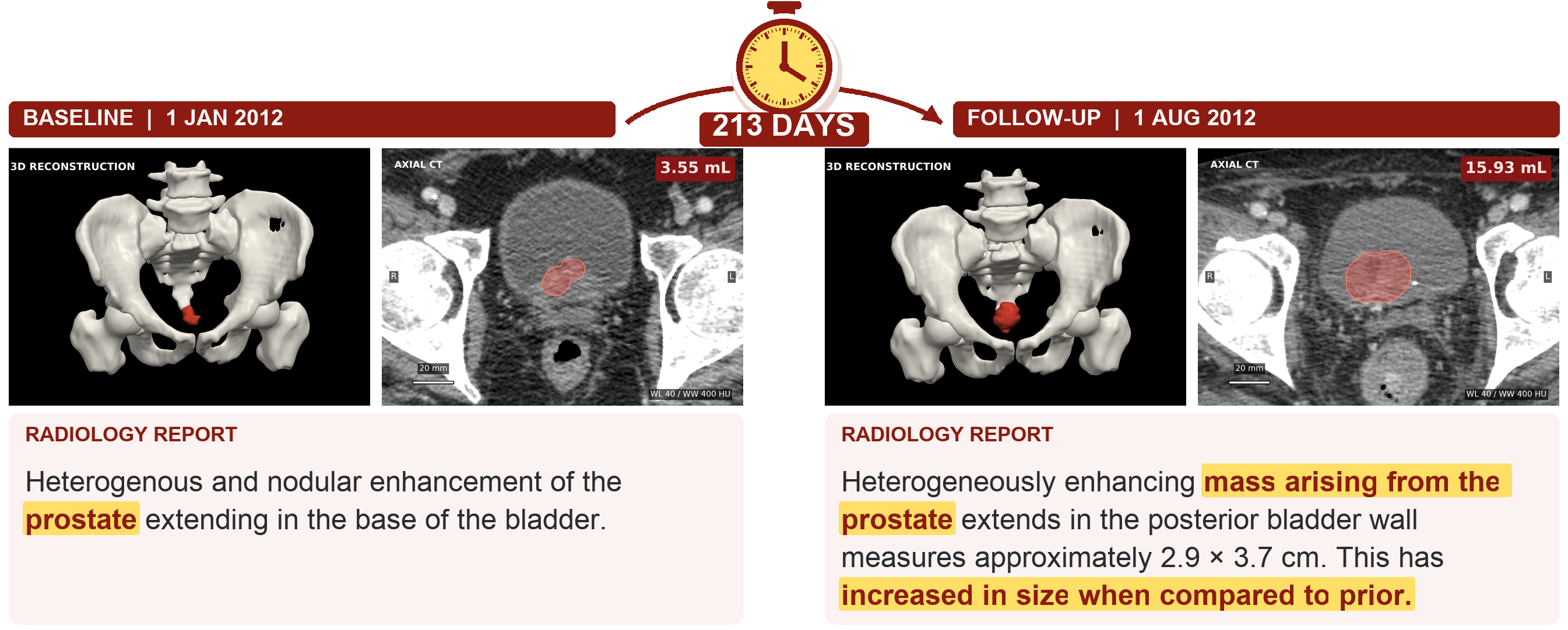 Longitudinal prostate tumor example with CT scans and report excerpts 213 days apart