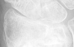 DistalRadius.bmp