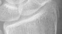 DistalRadius.bmp