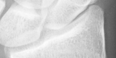 DistalRadius.bmp