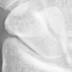 Scaphoid.bmp