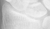 DistalRadius.bmp