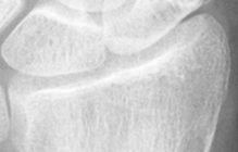 DistalRadius.bmp