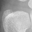 DistalUlna.bmp