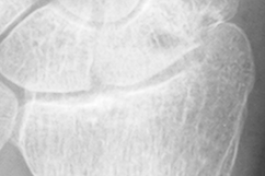 DistalRadius.bmp