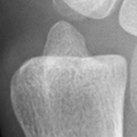 DistalUlna.bmp