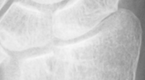 DistalRadius.bmp