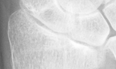 DistalRadius.bmp