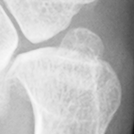 DistalUlna.bmp