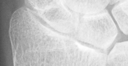 DistalRadius.bmp