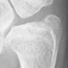 DistalUlna.bmp
