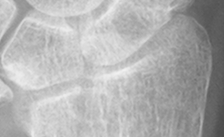 DistalRadius.bmp