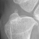 DistalUlna.bmp
