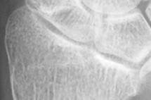 DistalRadius.bmp