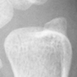 DistalUlna.bmp