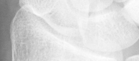 DistalRadius.bmp