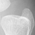 DistalUlna.bmp