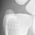 DistalUlna.bmp