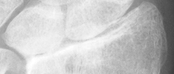 DistalRadius.bmp