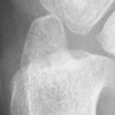 DistalUlna.bmp