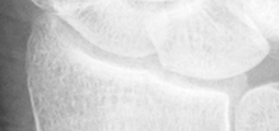DistalRadius.bmp