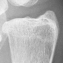 DistalUlna.bmp