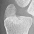 DistalUlna.bmp