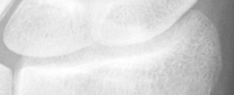 DistalRadius.bmp
