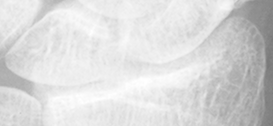 DistalRadius.bmp
