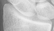 DistalRadius.bmp