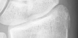 DistalRadius.bmp