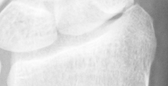 DistalRadius.bmp