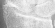 DistalRadius.bmp