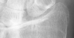 DistalRadius.bmp