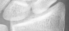 DistalRadius.bmp
