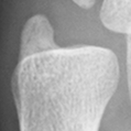 DistalUlna.bmp