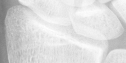 DistalRadius.bmp