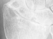 DistalRadius.bmp