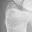 DistalUlna.bmp