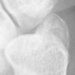 DistalUlna.bmp