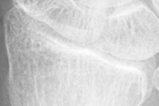 DistalRadius.bmp