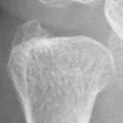 DistalUlna.bmp